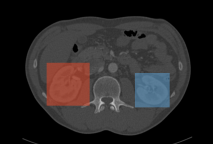 Kidney detection